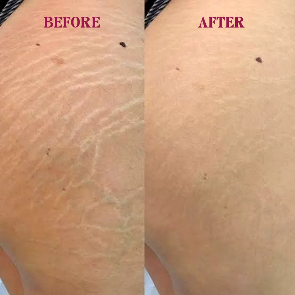 Markless Veil – Stretch Mark Serum