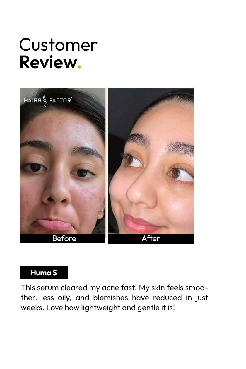 ANTI ACNE SERUM (30ml) (GURANTEED RESULTS IN 14-DAYS)